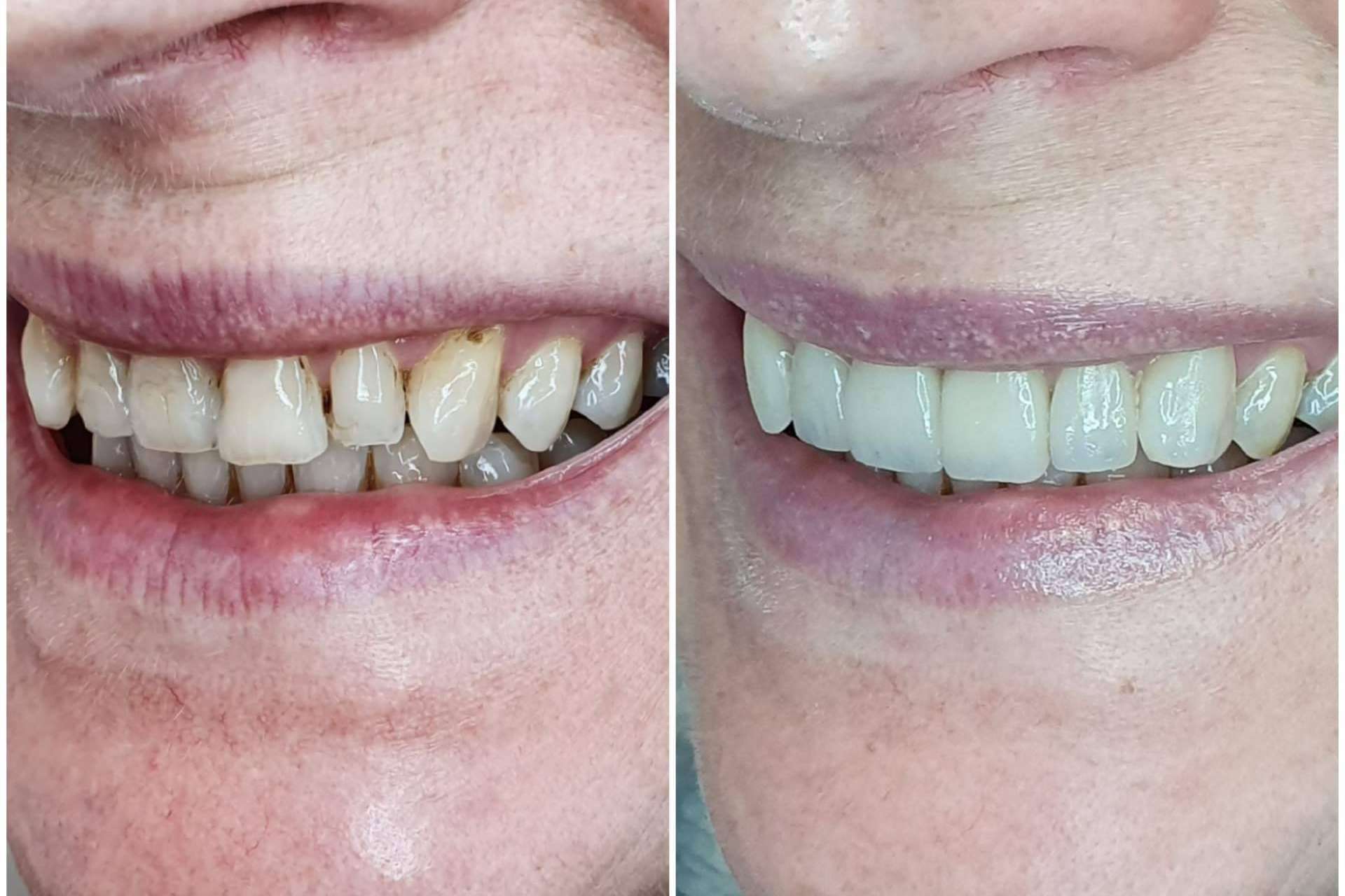 Estética dental en 2 visitas, con Dentinova