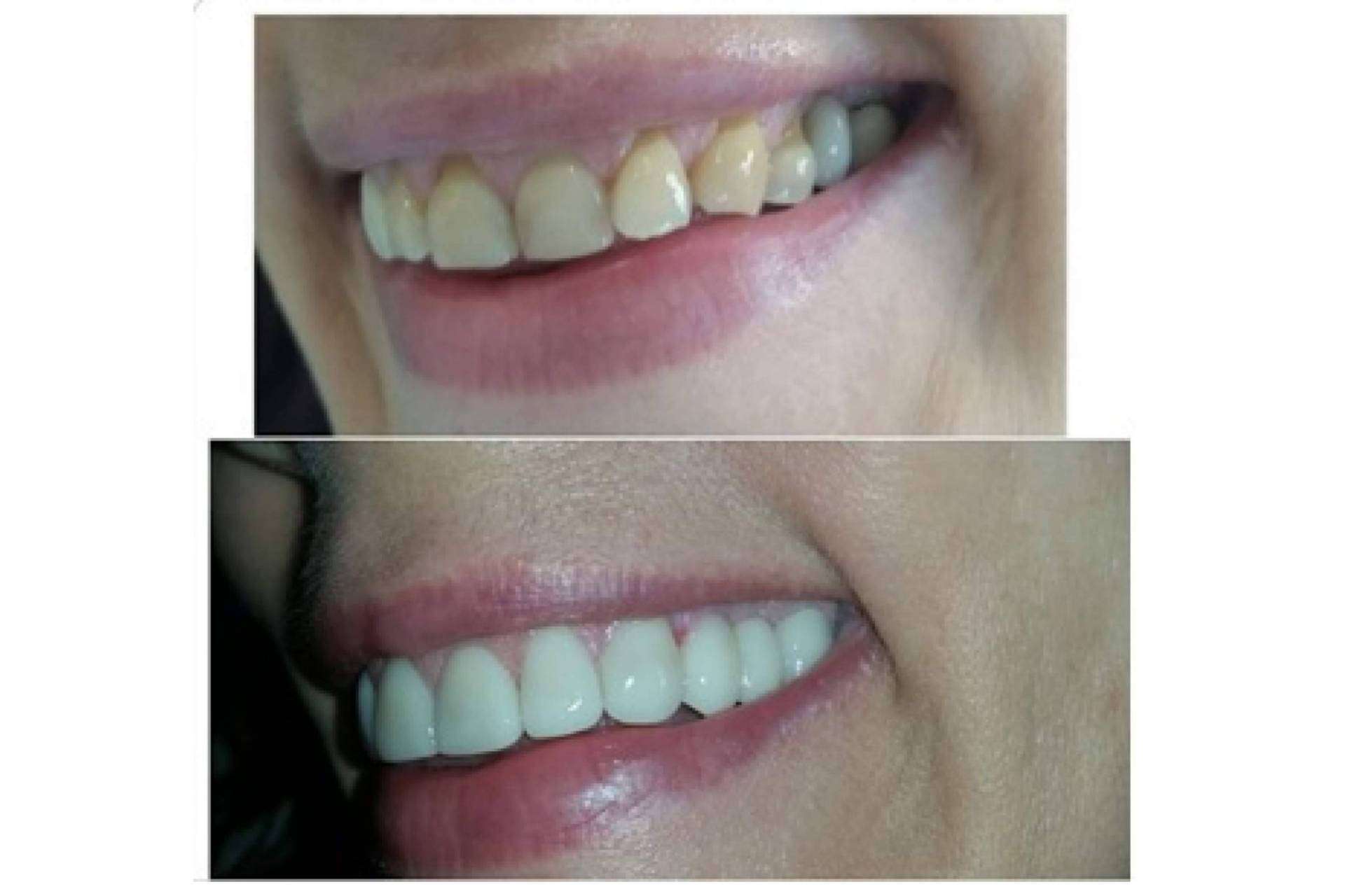 Una posible causa de divorcio, la halitosis
