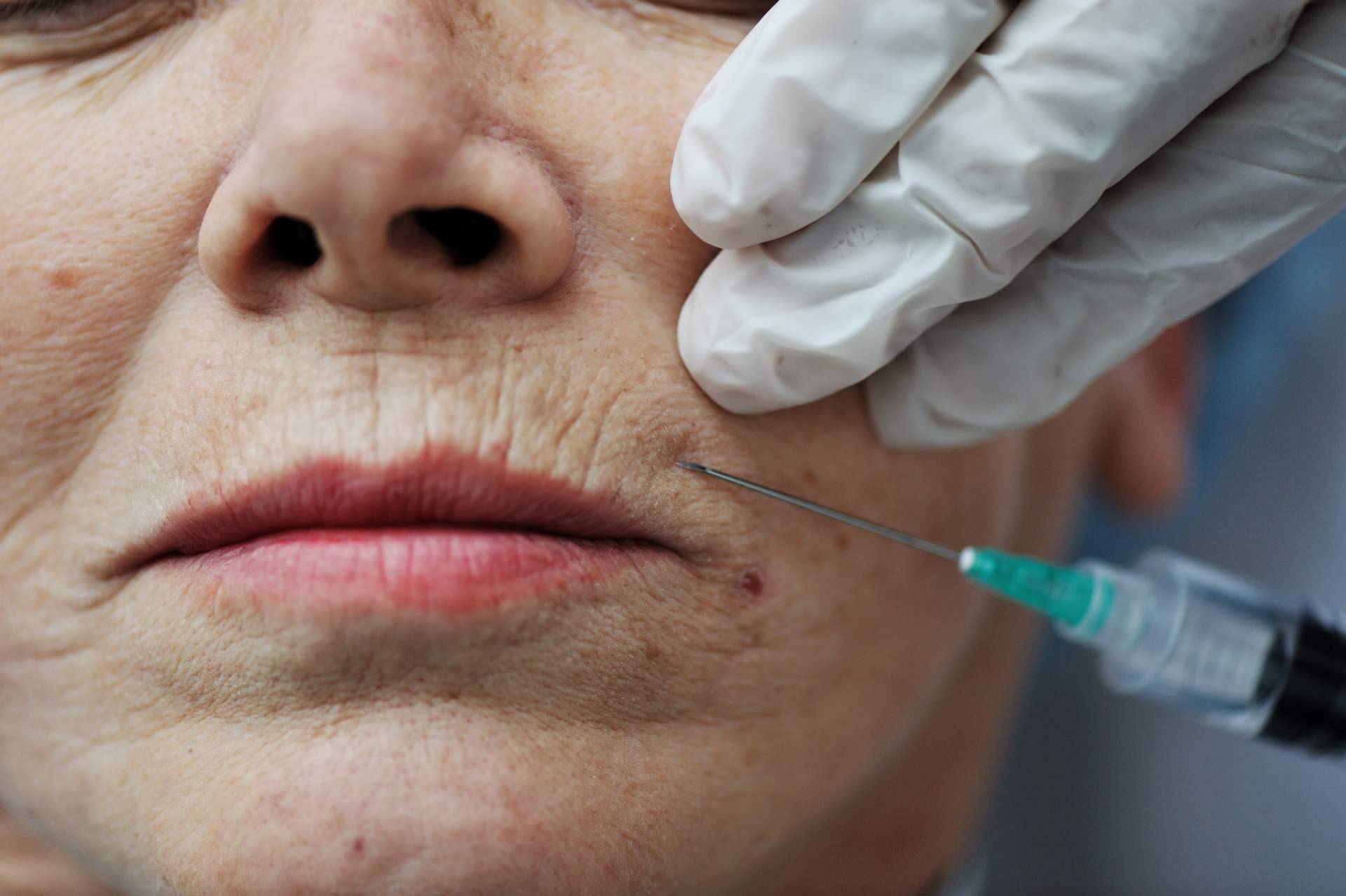 Centro Estética El Pilar ofrece tratamiento de plasma rico en plaquetas en Madrid