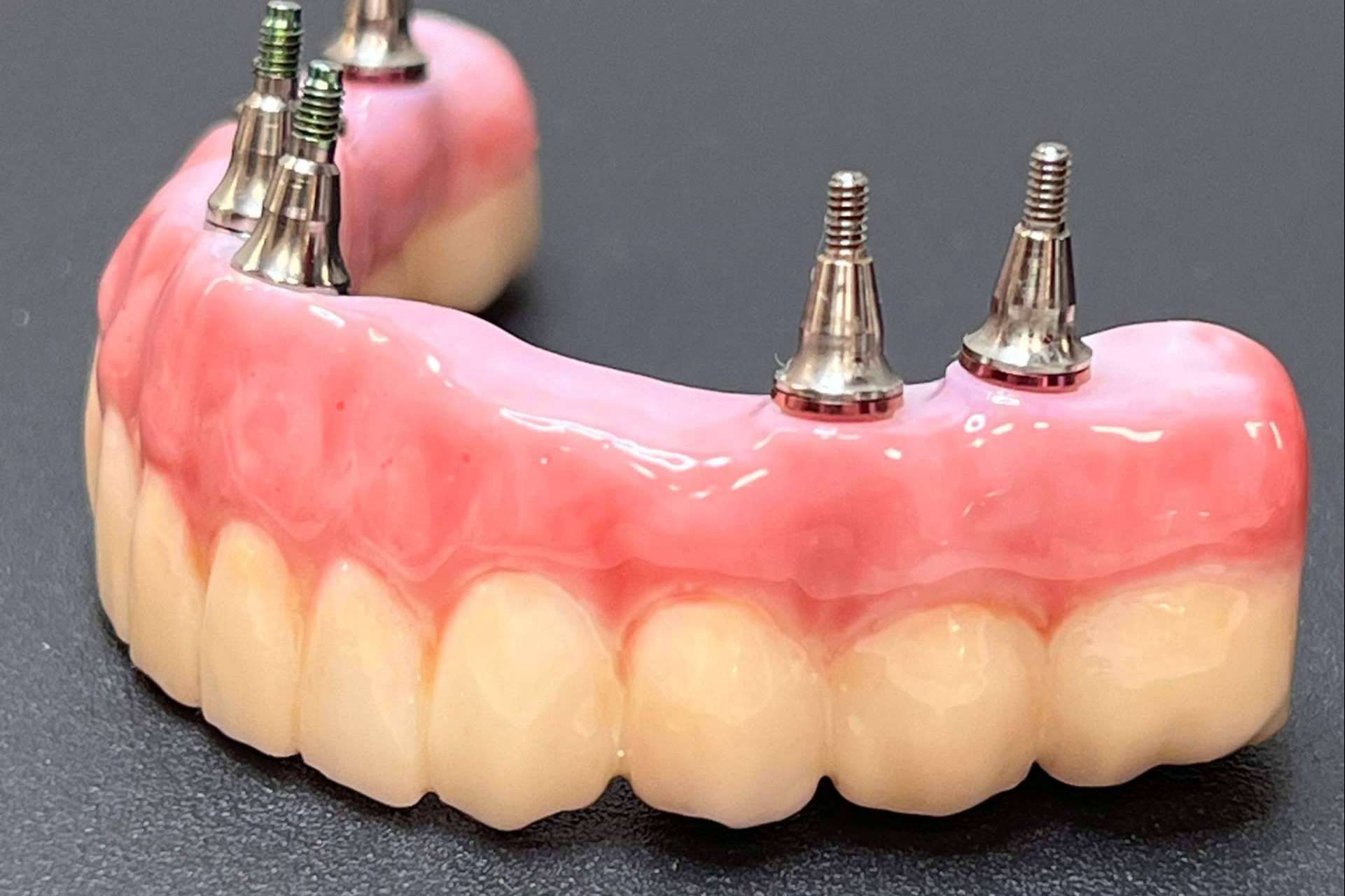 Los servicios de Dentinova permiten realizar implantes y extracciones dentales inmediatos en una misma sesión