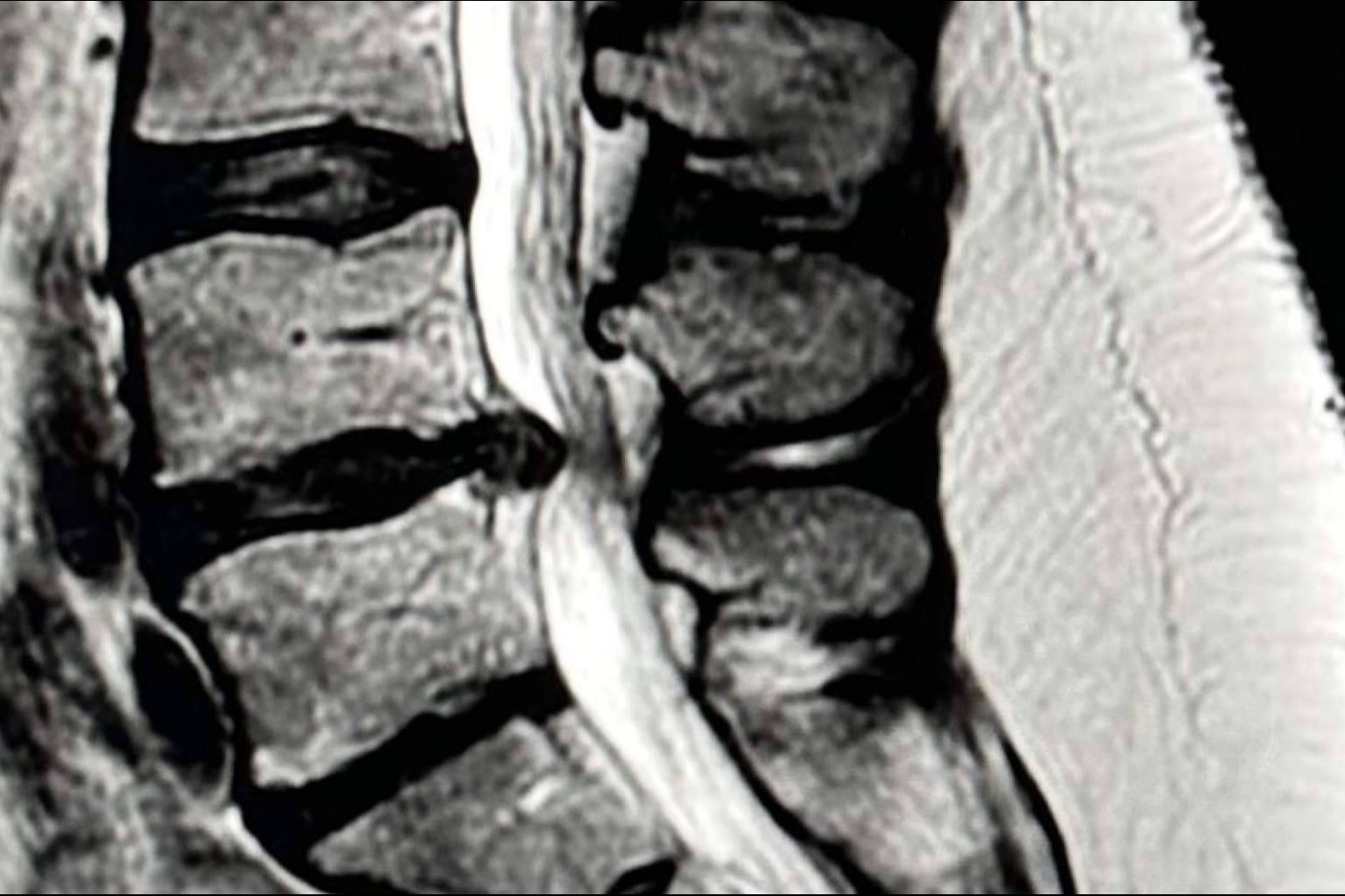Entrevista al Dr. Botella-Asunción; Microdiscectomía vs. Discectomía endoscópica en la hernia discal lumbar