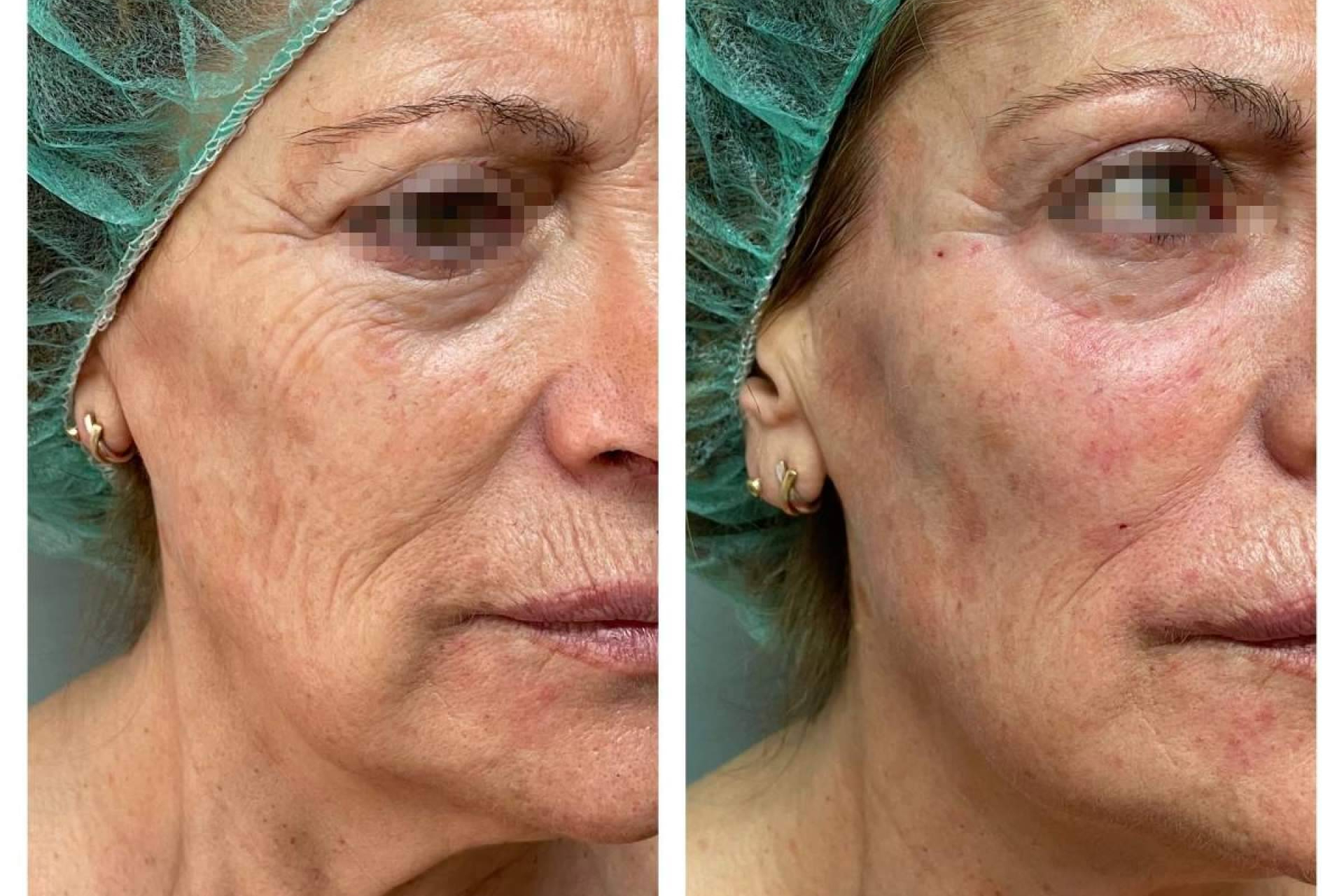 ¿Qué está impulsando la popularidad del lipofilling facial en 2026 frente al ácido hialurónico?